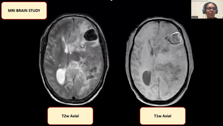 Scrub typhus epidemic at its worst: A paediatric imaging case report